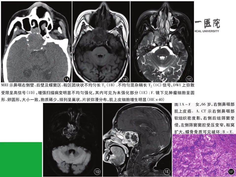 【病例】鼻咽部肌上皮癌1例CT及MR影像-14