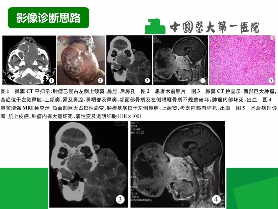 【病例】鼻咽部肌上皮癌1例CT及MR影像-16