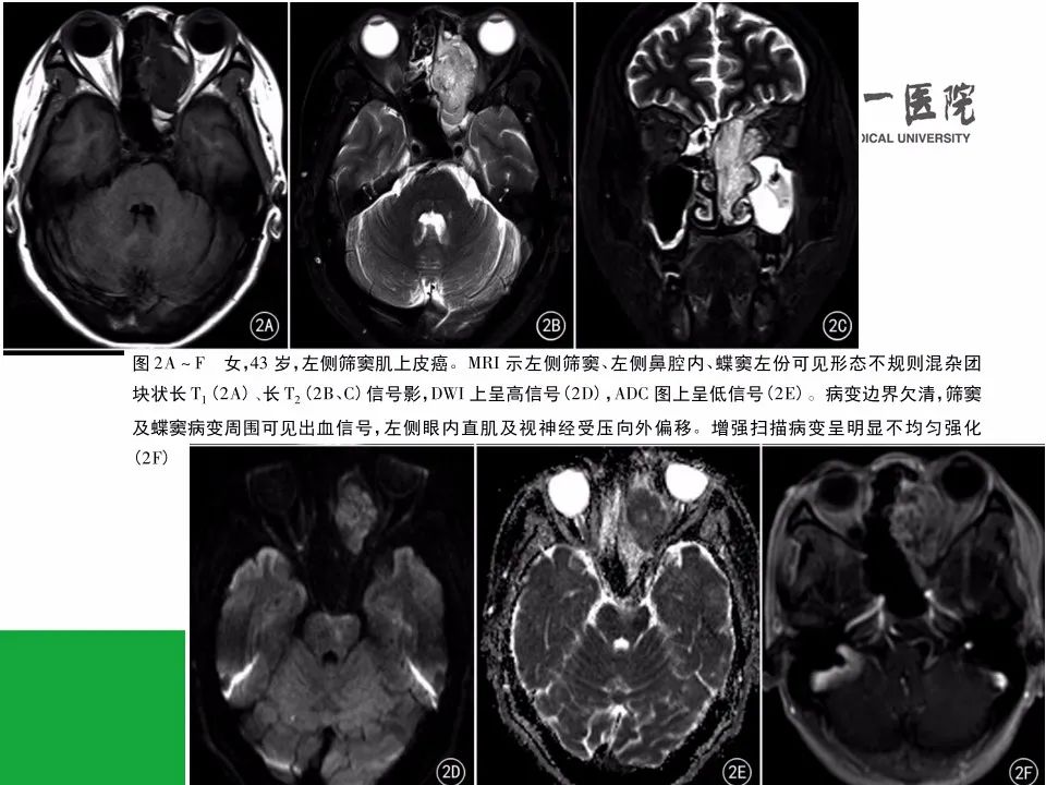 【病例】鼻咽部肌上皮癌1例CT及MR影像-15