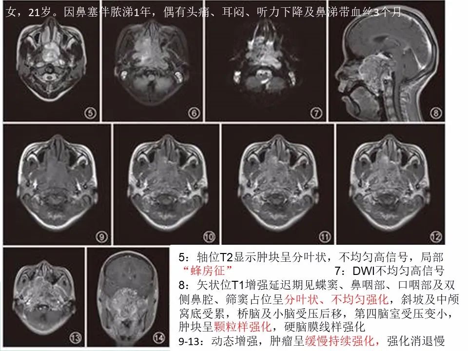 【病例】鼻咽部肌上皮癌1例CT及MR影像-20