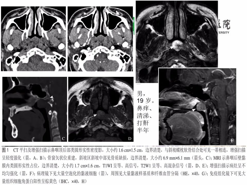 【病例】鼻咽部肌上皮癌1例CT及MR影像-21