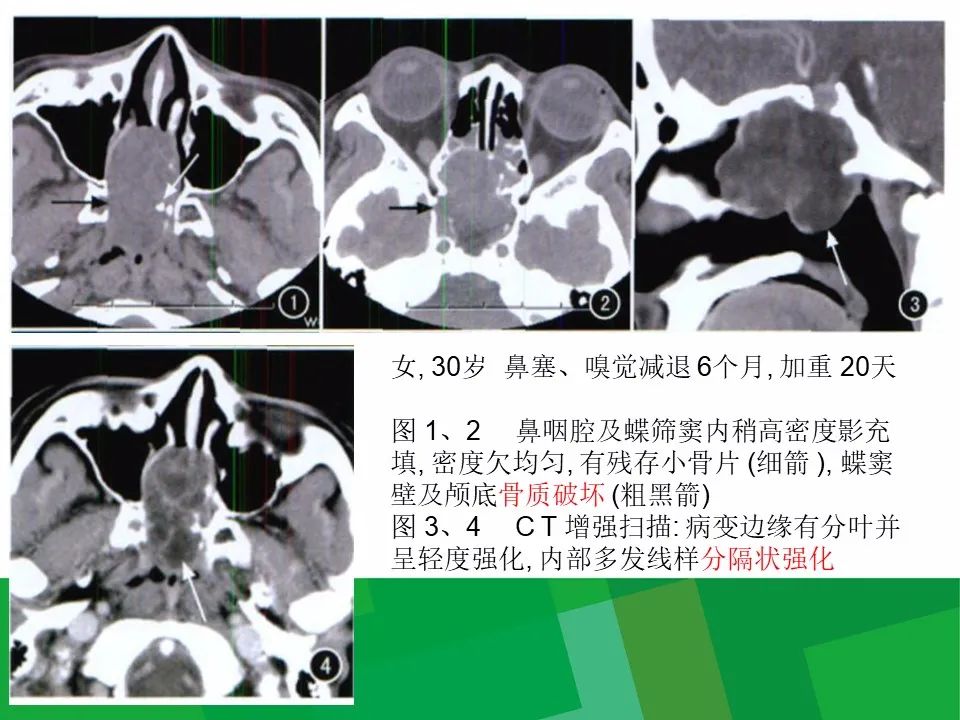 【病例】鼻咽部肌上皮癌1例CT及MR影像-22