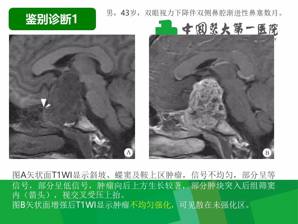 【病例】鼻咽部肌上皮癌1例CT及MR影像-23