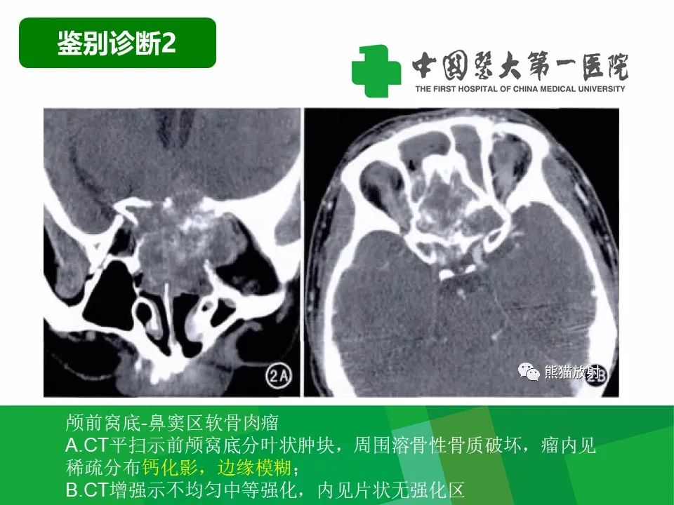 【病例】鼻咽部肌上皮癌1例CT及MR影像-25