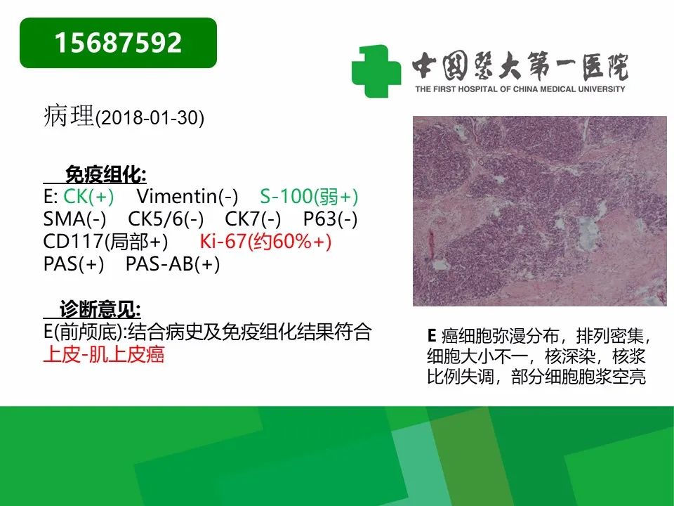 【病例】鼻咽部肌上皮癌1例CT及MR影像-29