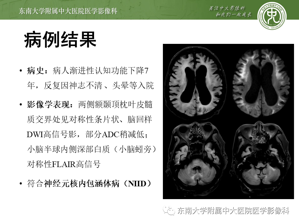 【PPT】神经元核内包涵体病（NIID）的影像学诊断-2