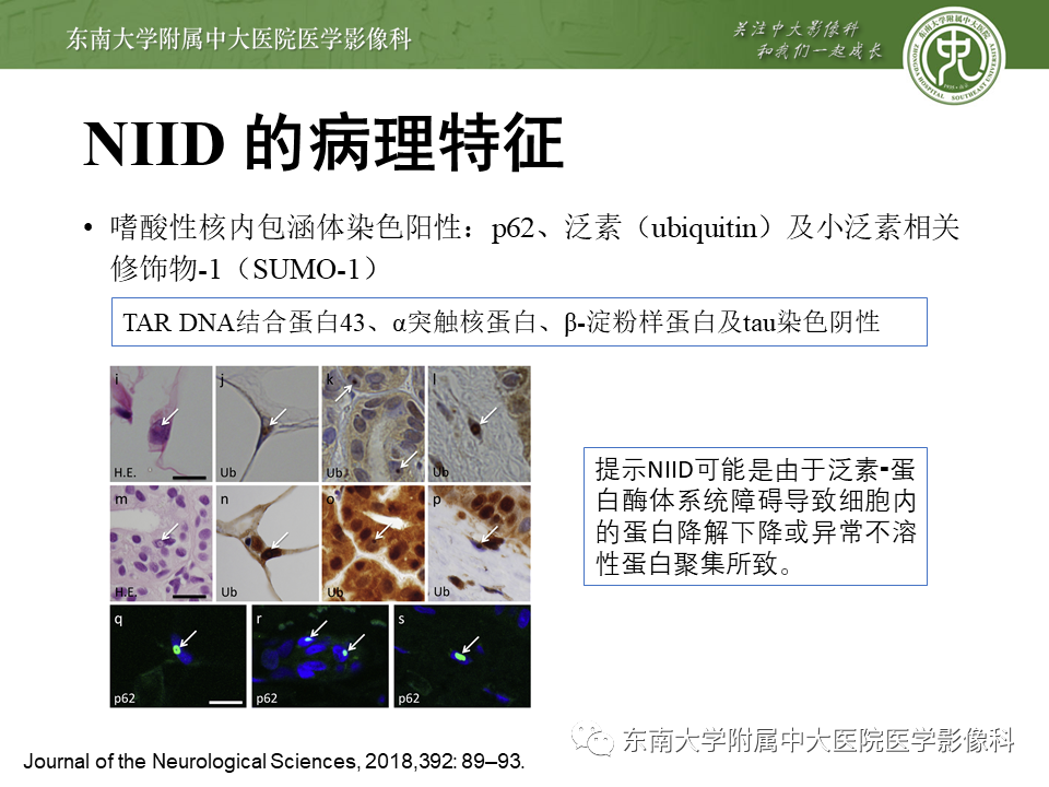 【PPT】神经元核内包涵体病（NIID）的影像学诊断-9