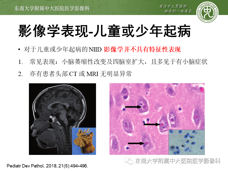 【PPT】神经元核内包涵体病（NIID）的影像学诊断-15