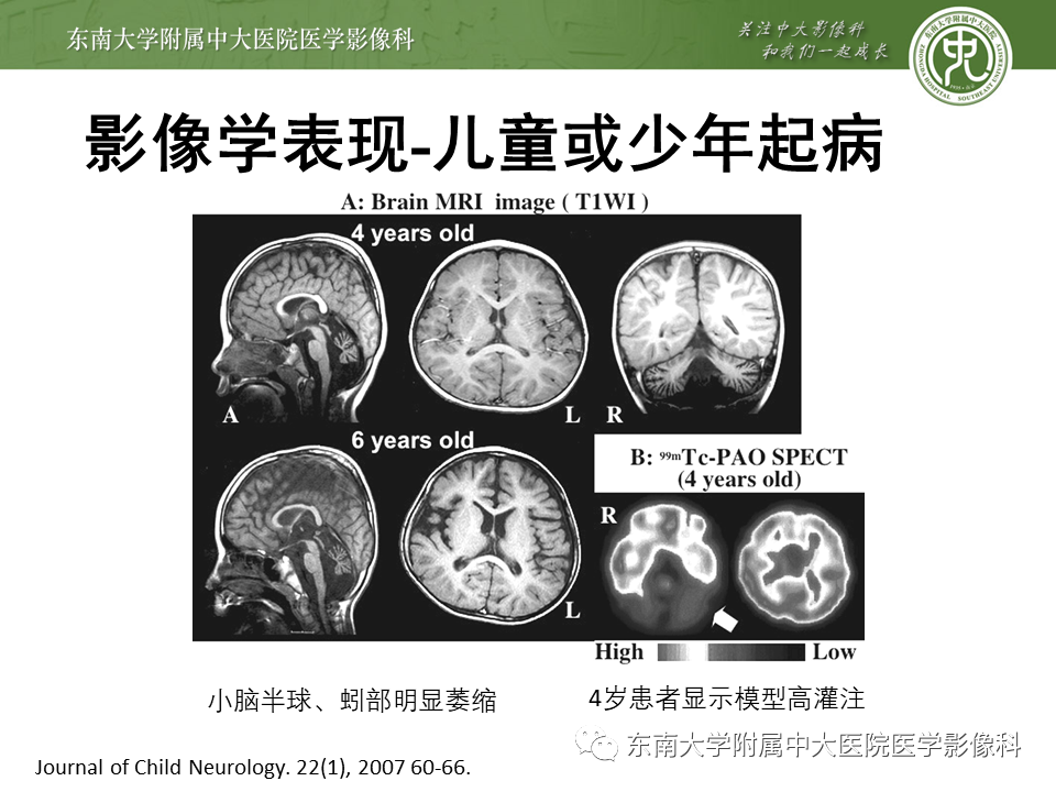【PPT】神经元核内包涵体病（NIID）的影像学诊断-16