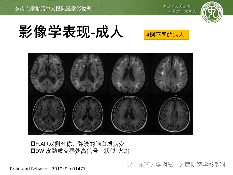 【PPT】神经元核内包涵体病（NIID）的影像学诊断-18