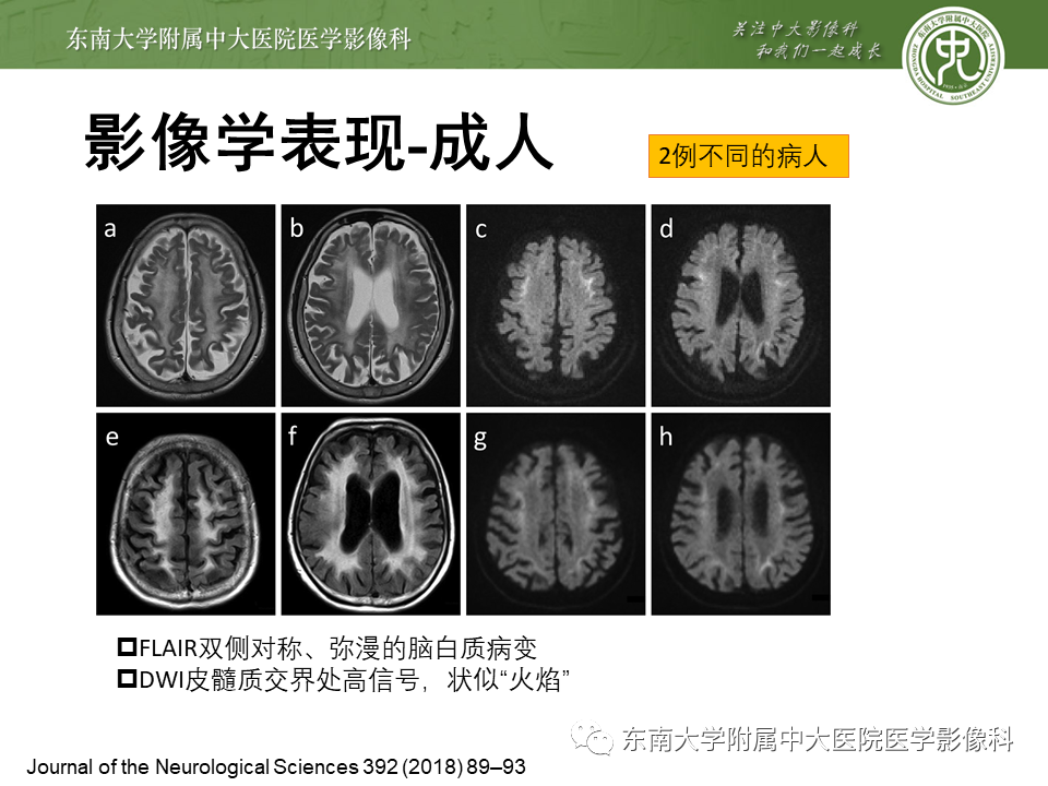 【PPT】神经元核内包涵体病（NIID）的影像学诊断-19