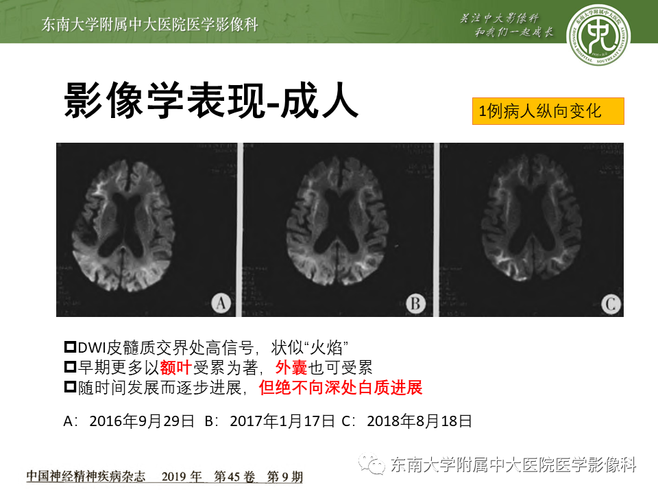 【PPT】神经元核内包涵体病（NIID）的影像学诊断-20