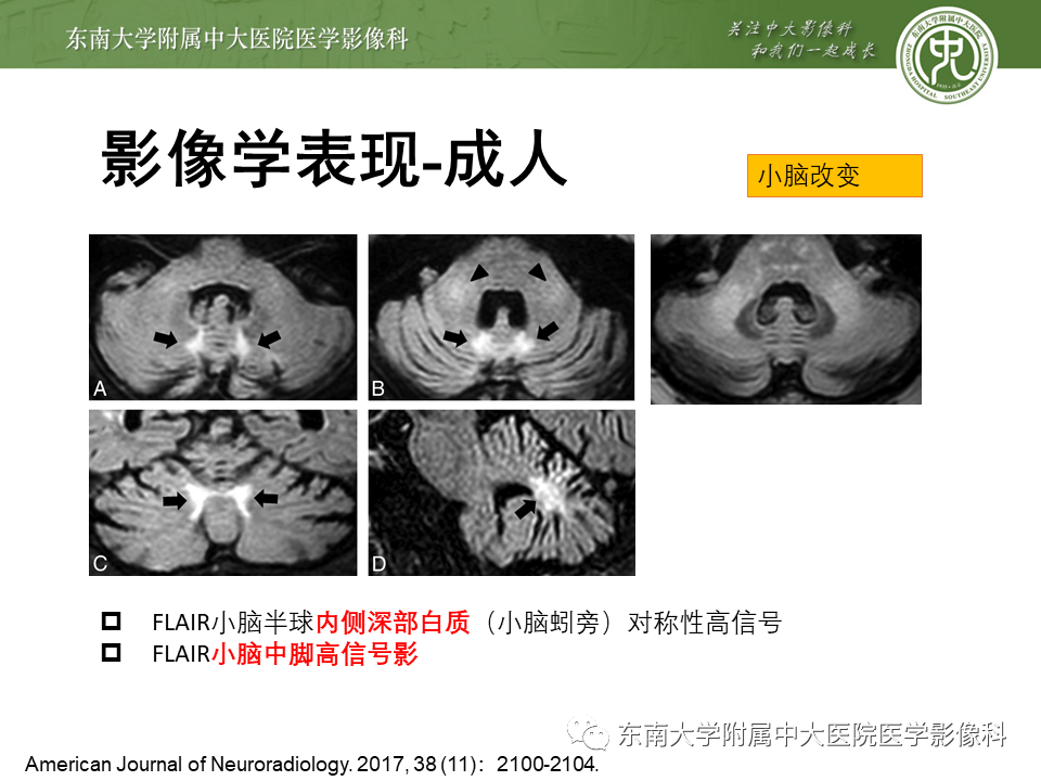 【PPT】神经元核内包涵体病（NIID）的影像学诊断-21