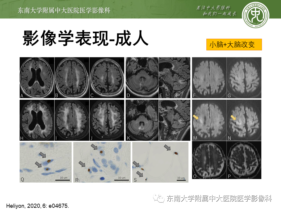 【PPT】神经元核内包涵体病（NIID）的影像学诊断-23
