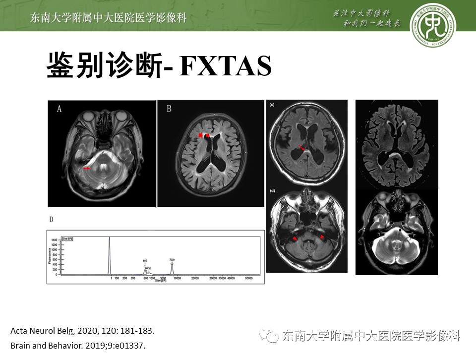 【PPT】神经元核内包涵体病（NIID）的影像学诊断-26