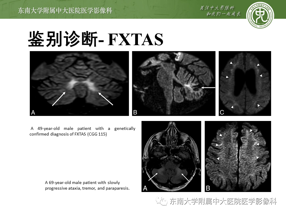 【PPT】神经元核内包涵体病（NIID）的影像学诊断-27