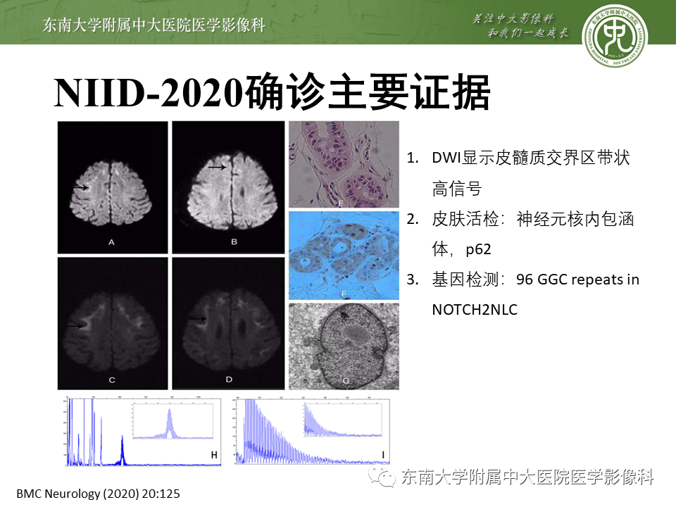 【PPT】神经元核内包涵体病（NIID）的影像学诊断-29