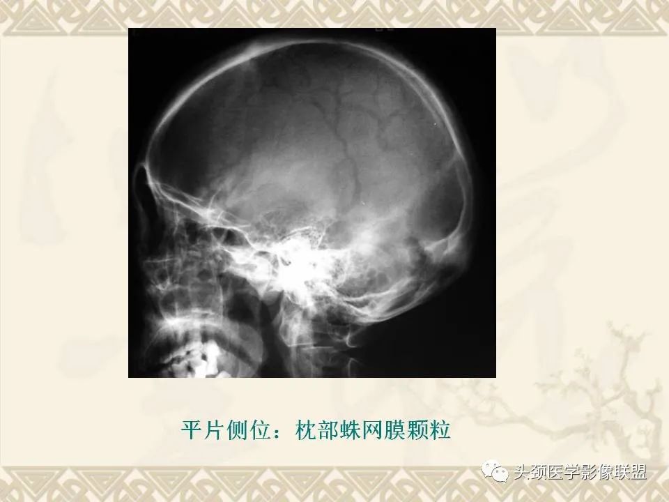 【PPT】颅骨肿瘤的影像学诊断与鉴别诊断-4