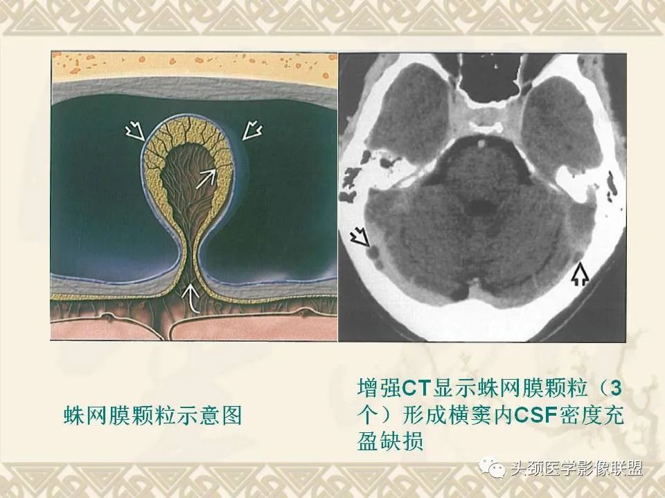 【PPT】颅骨肿瘤的影像学诊断与鉴别诊断-3