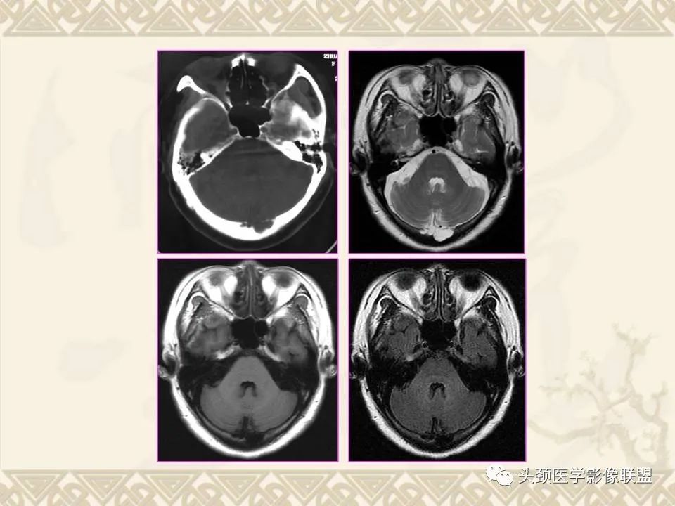 【PPT】颅骨肿瘤的影像学诊断与鉴别诊断-5