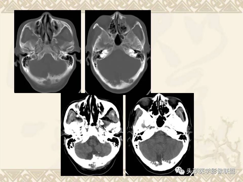 【PPT】颅骨肿瘤的影像学诊断与鉴别诊断-6