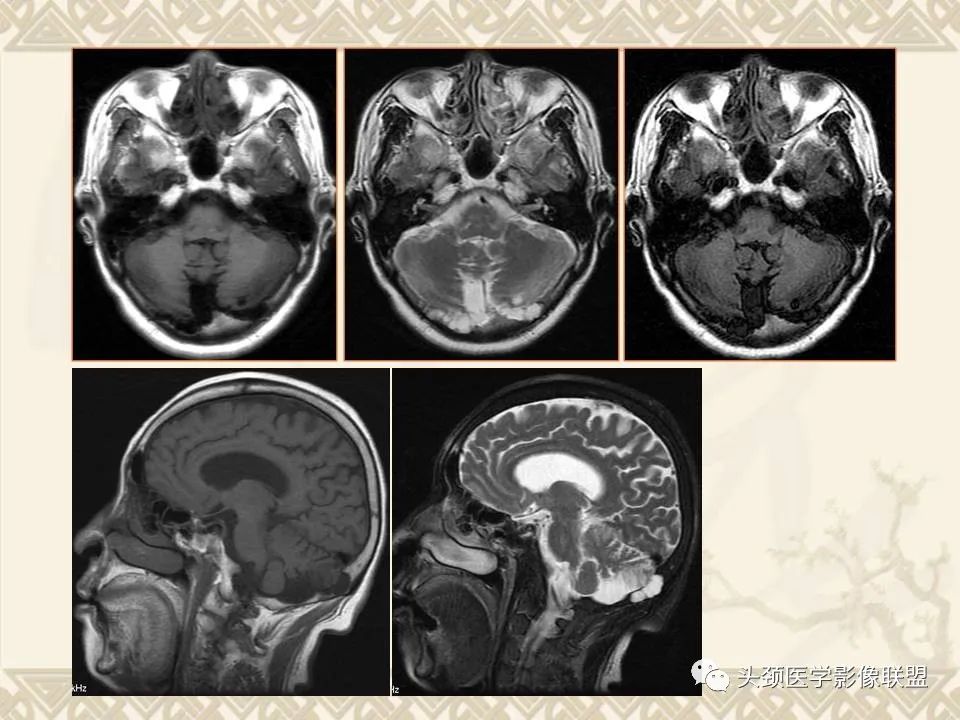 【PPT】颅骨肿瘤的影像学诊断与鉴别诊断-7