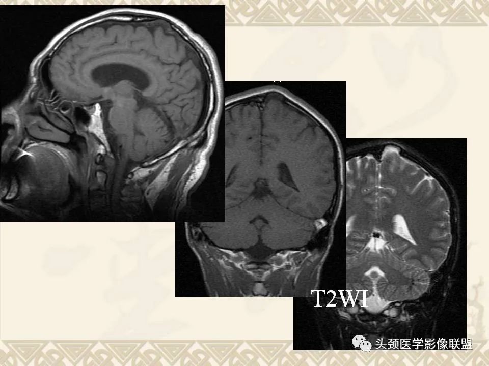 【PPT】颅骨肿瘤的影像学诊断与鉴别诊断-8