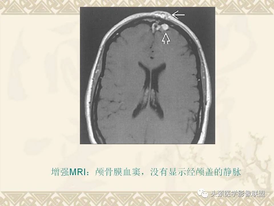 【PPT】颅骨肿瘤的影像学诊断与鉴别诊断-10