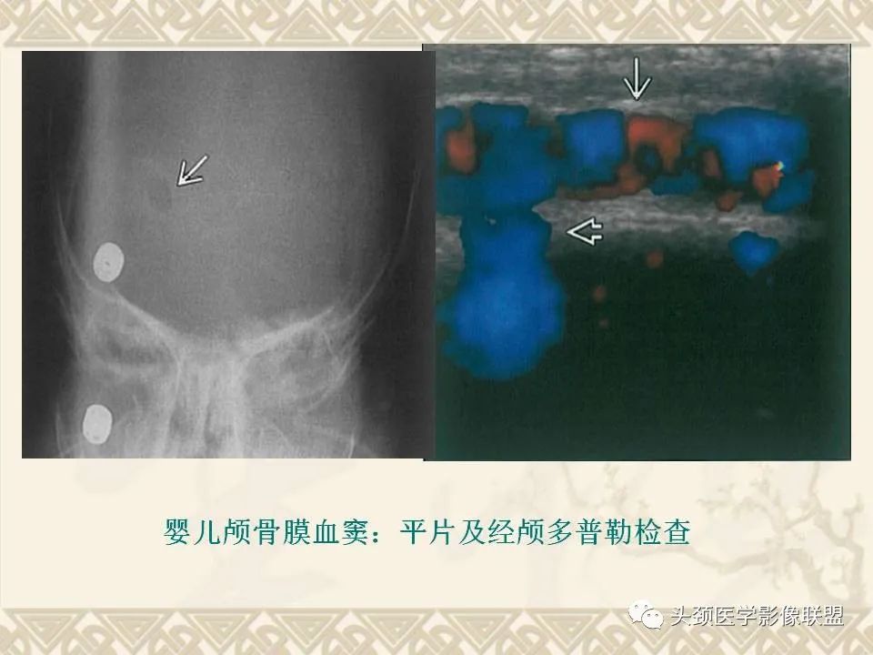 【PPT】颅骨肿瘤的影像学诊断与鉴别诊断-11