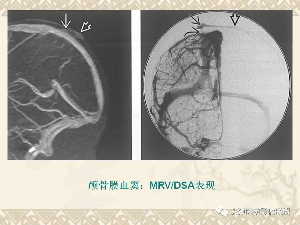 【PPT】颅骨肿瘤的影像学诊断与鉴别诊断-13