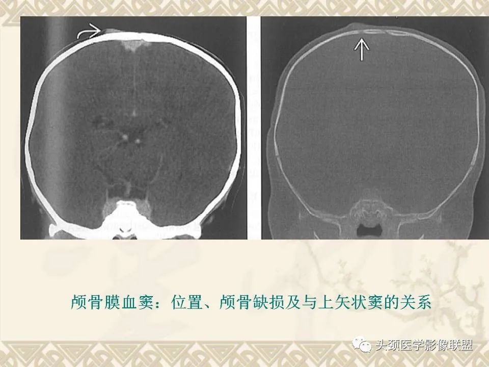 【PPT】颅骨肿瘤的影像学诊断与鉴别诊断-12