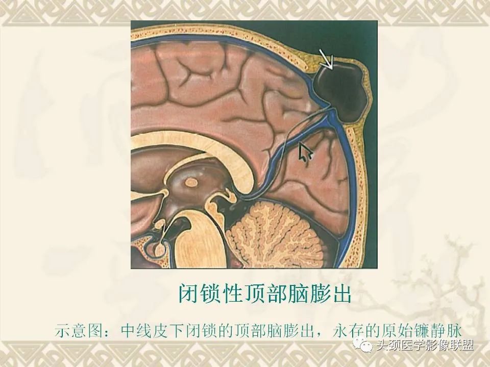 【PPT】颅骨肿瘤的影像学诊断与鉴别诊断-14