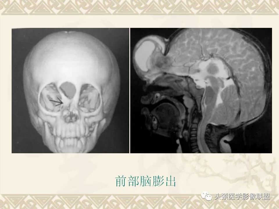 【PPT】颅骨肿瘤的影像学诊断与鉴别诊断-16