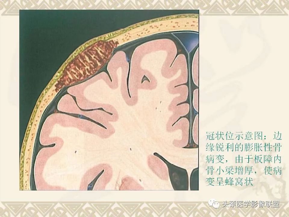 【PPT】颅骨肿瘤的影像学诊断与鉴别诊断-19