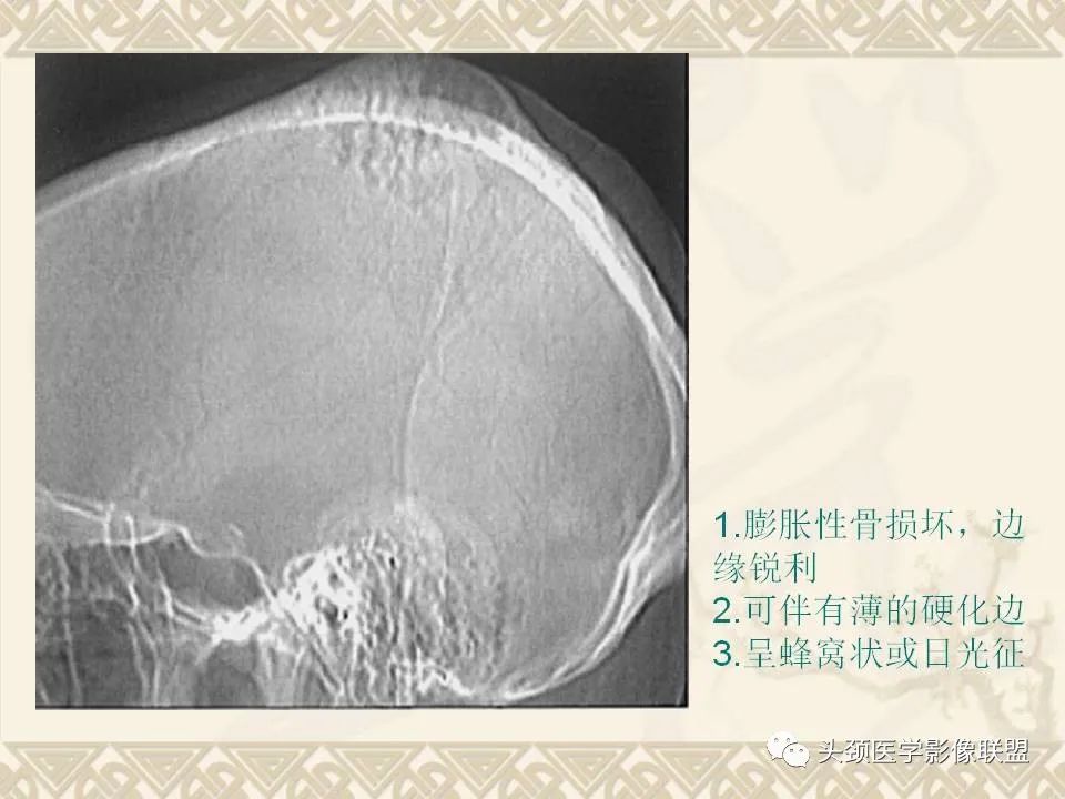 【PPT】颅骨肿瘤的影像学诊断与鉴别诊断-20