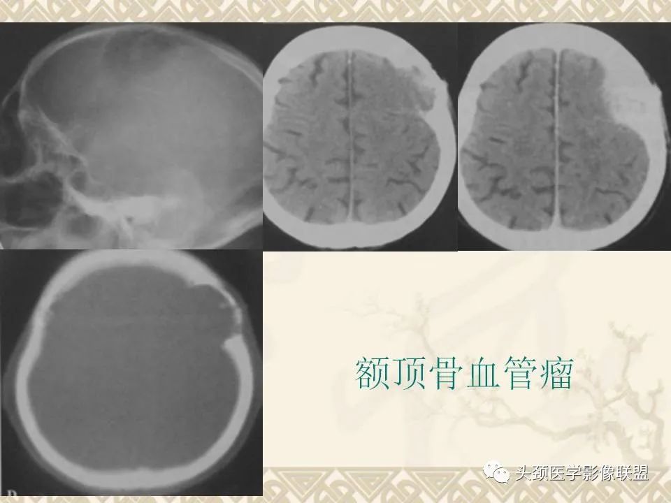 【PPT】颅骨肿瘤的影像学诊断与鉴别诊断-23
