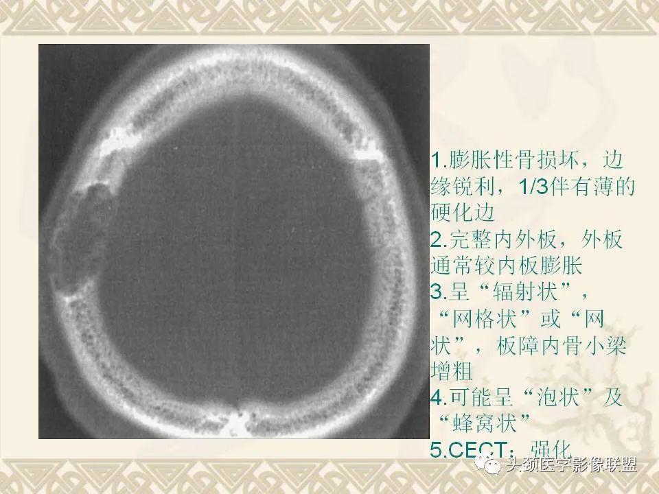 【PPT】颅骨肿瘤的影像学诊断与鉴别诊断-21