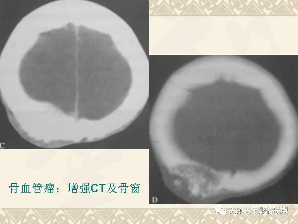 【PPT】颅骨肿瘤的影像学诊断与鉴别诊断-22