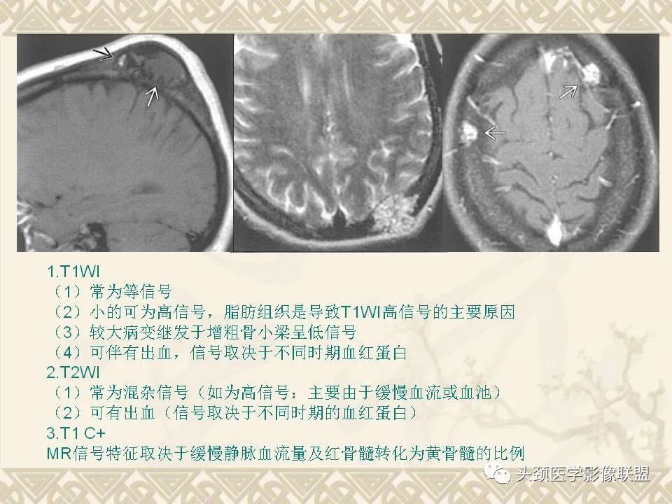 【PPT】颅骨肿瘤的影像学诊断与鉴别诊断-24