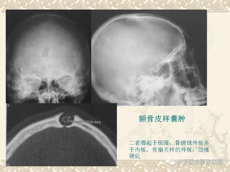 【PPT】颅骨肿瘤的影像学诊断与鉴别诊断-26