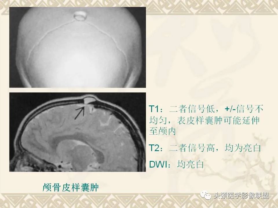 【PPT】颅骨肿瘤的影像学诊断与鉴别诊断-28