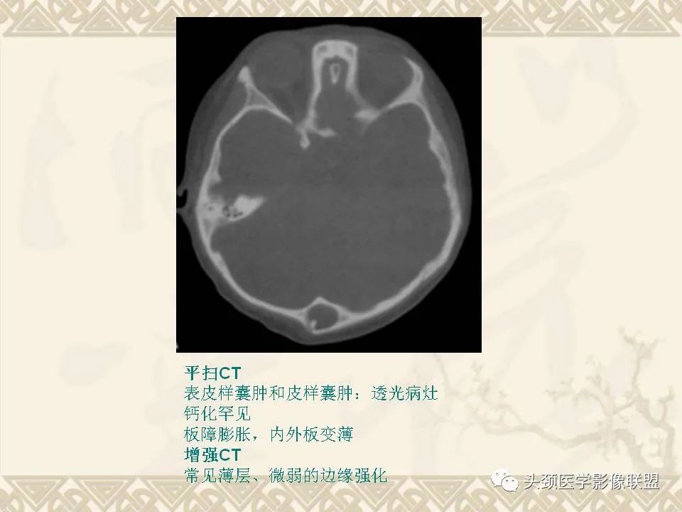 【PPT】颅骨肿瘤的影像学诊断与鉴别诊断-27