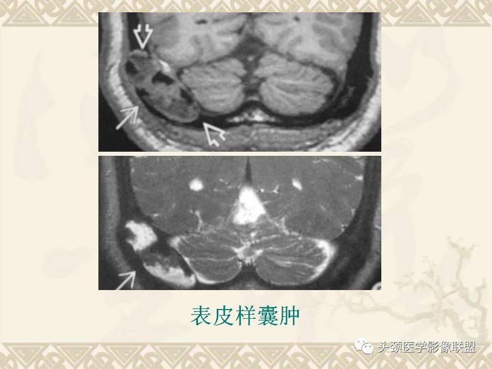 【PPT】颅骨肿瘤的影像学诊断与鉴别诊断-29