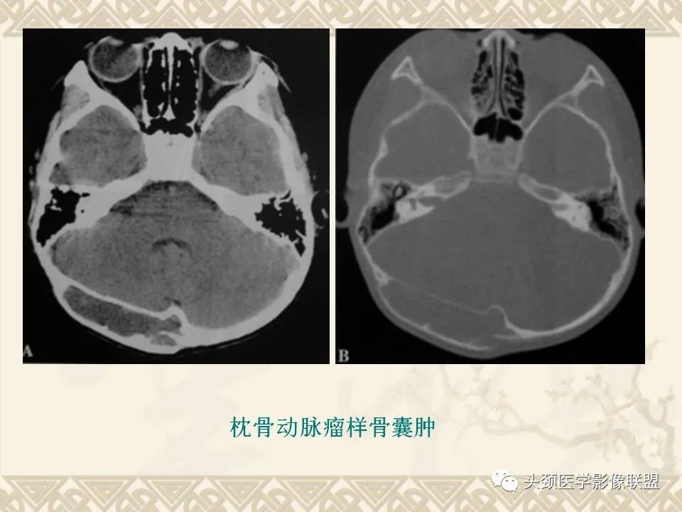 【PPT】颅骨肿瘤的影像学诊断与鉴别诊断-31