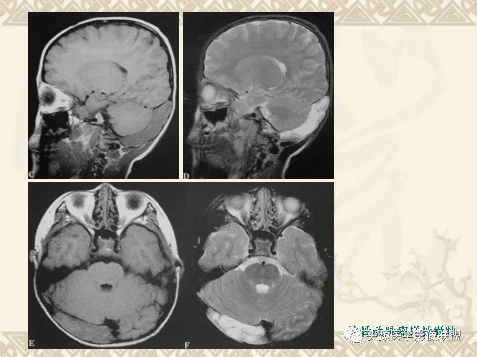 【PPT】颅骨肿瘤的影像学诊断与鉴别诊断-32