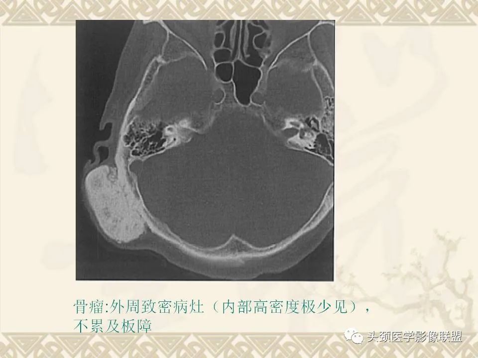 【PPT】颅骨肿瘤的影像学诊断与鉴别诊断-34