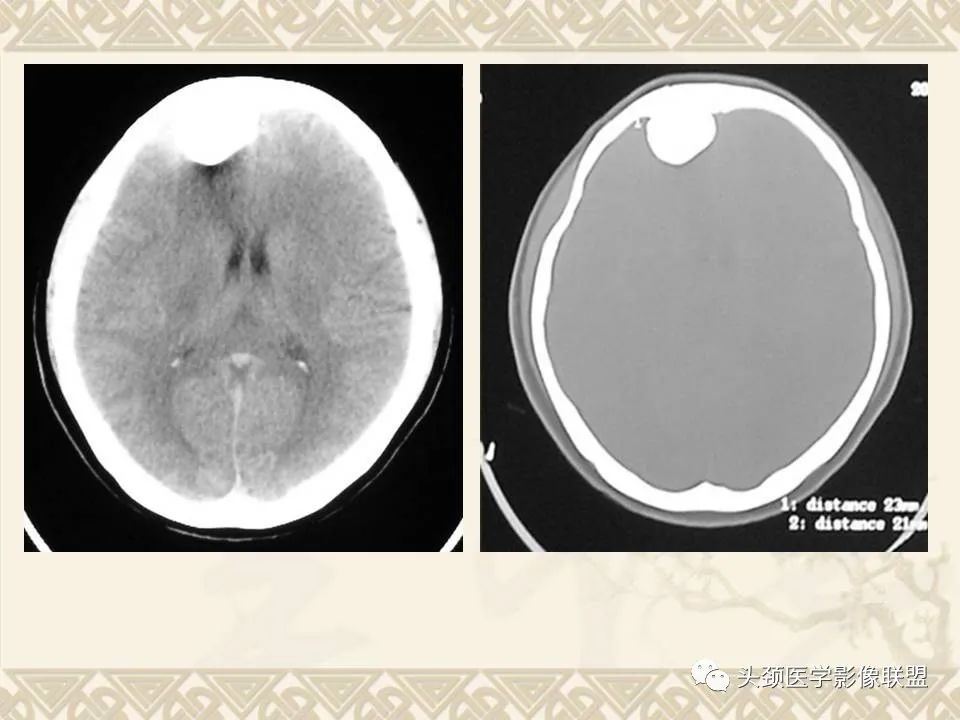 【PPT】颅骨肿瘤的影像学诊断与鉴别诊断-35