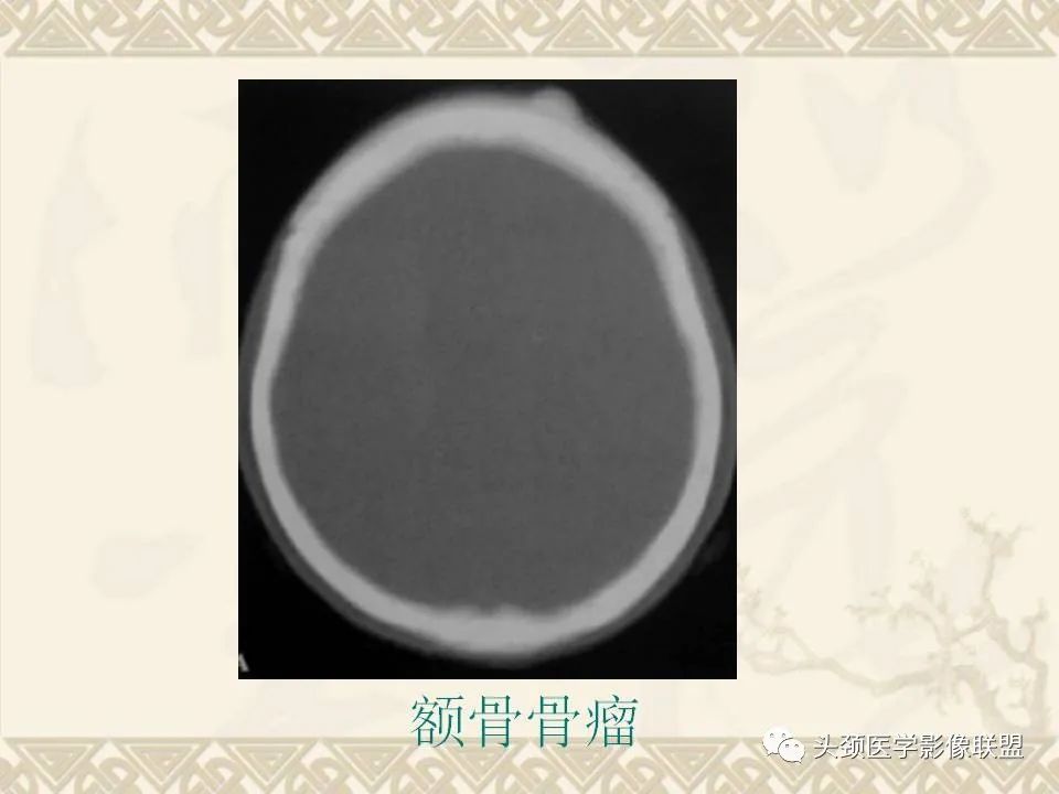 【PPT】颅骨肿瘤的影像学诊断与鉴别诊断-36