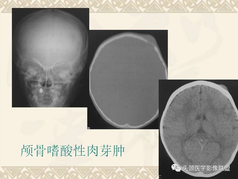 【PPT】颅骨肿瘤的影像学诊断与鉴别诊断-40
