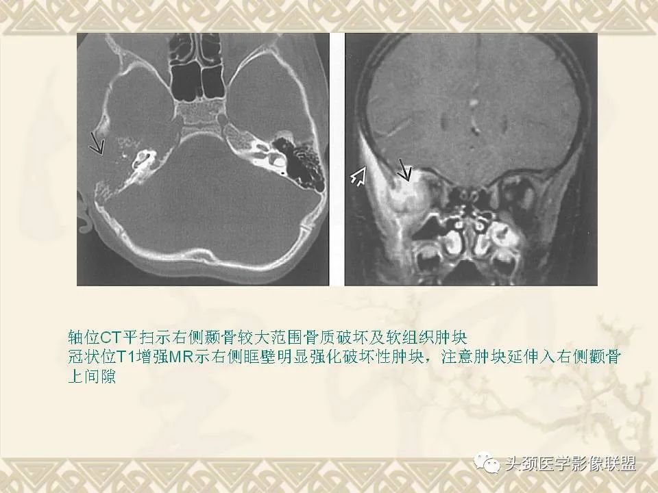 【PPT】颅骨肿瘤的影像学诊断与鉴别诊断-42